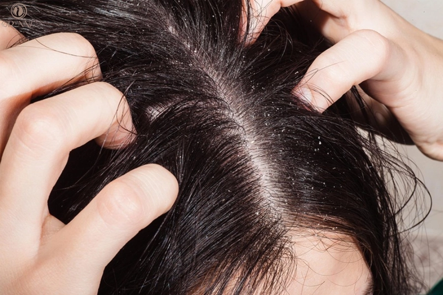 Nguyên Nhân Ngứa Da Đầu Và Giải Pháp Khắc Phục Hiệu Quả