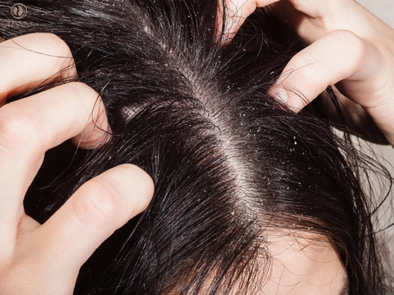 Ngứa da đầu là gì và tại sao bạn bị ngứa?